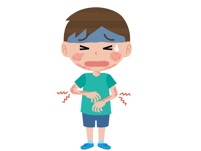 アトピー性皮膚炎
